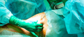 Fettabsaugung, Liposuktion