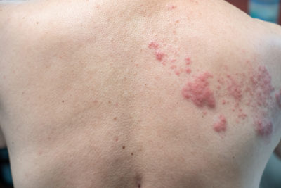 Herpes zoster Guertelrose Gürtelrose