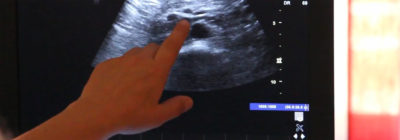 Sonografische Untersuchungen erfordern ein geübtes Auge und profundes Wissen der physiologischen Kartografie, um sich in den granularen Darstellungen zurecht zu finden. „Der Hausarzt" zeigt, worauf es bei der Untersuchung des Abdomens ankommt und wie Sie den Pankreas sicher finden.