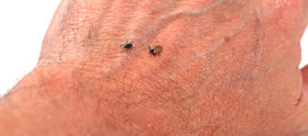 Zecken auf der Hand