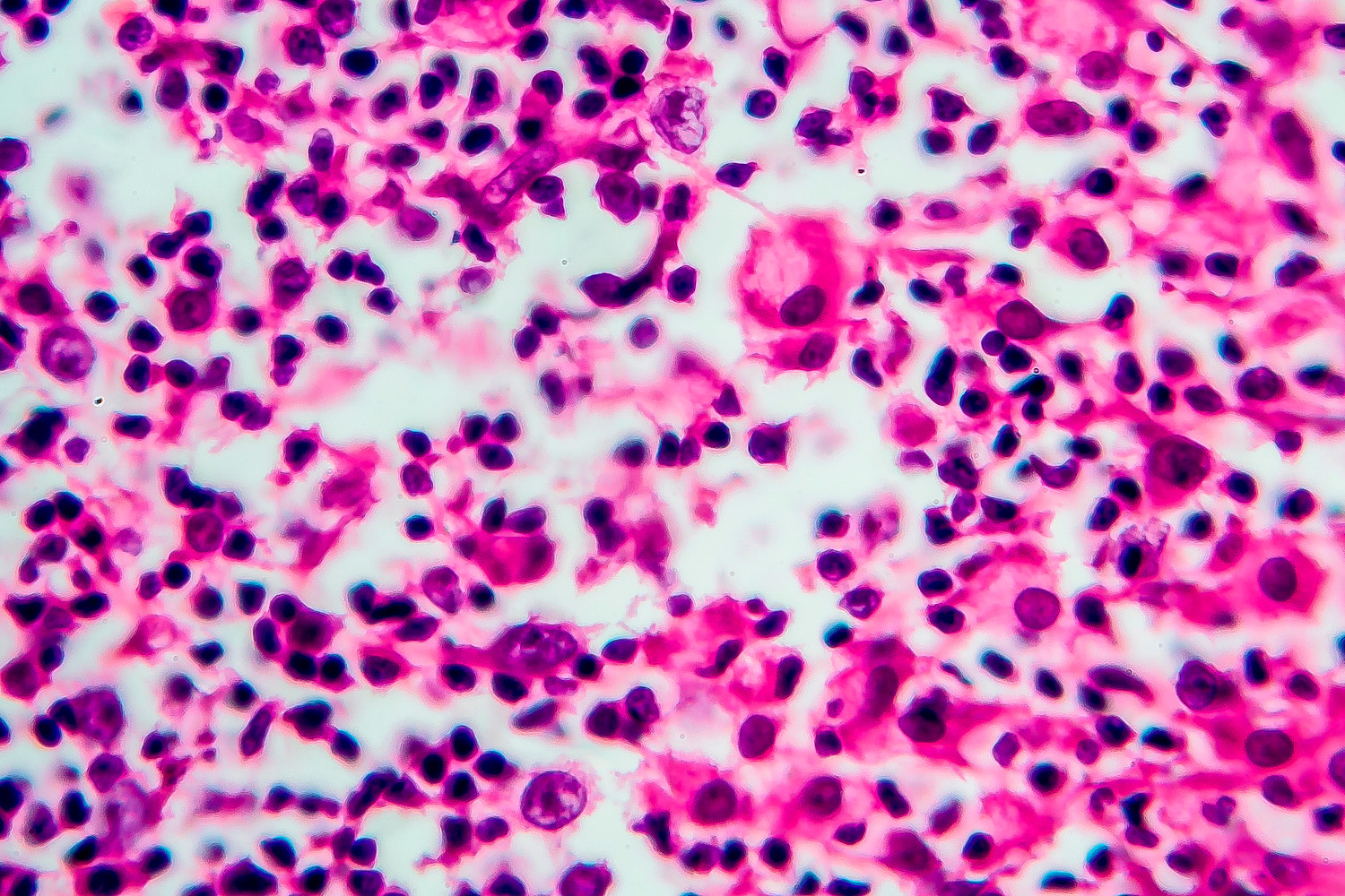 Das Hodgkin-Lymphom ist nach einem genialen Wissenschaftler benannt, der als einer der berühmtesten Ärzte seiner Zeit galt und dennoch nicht als Kliniker arbeiten durfte, weil er Quäker war: Thomas Hodgkin.