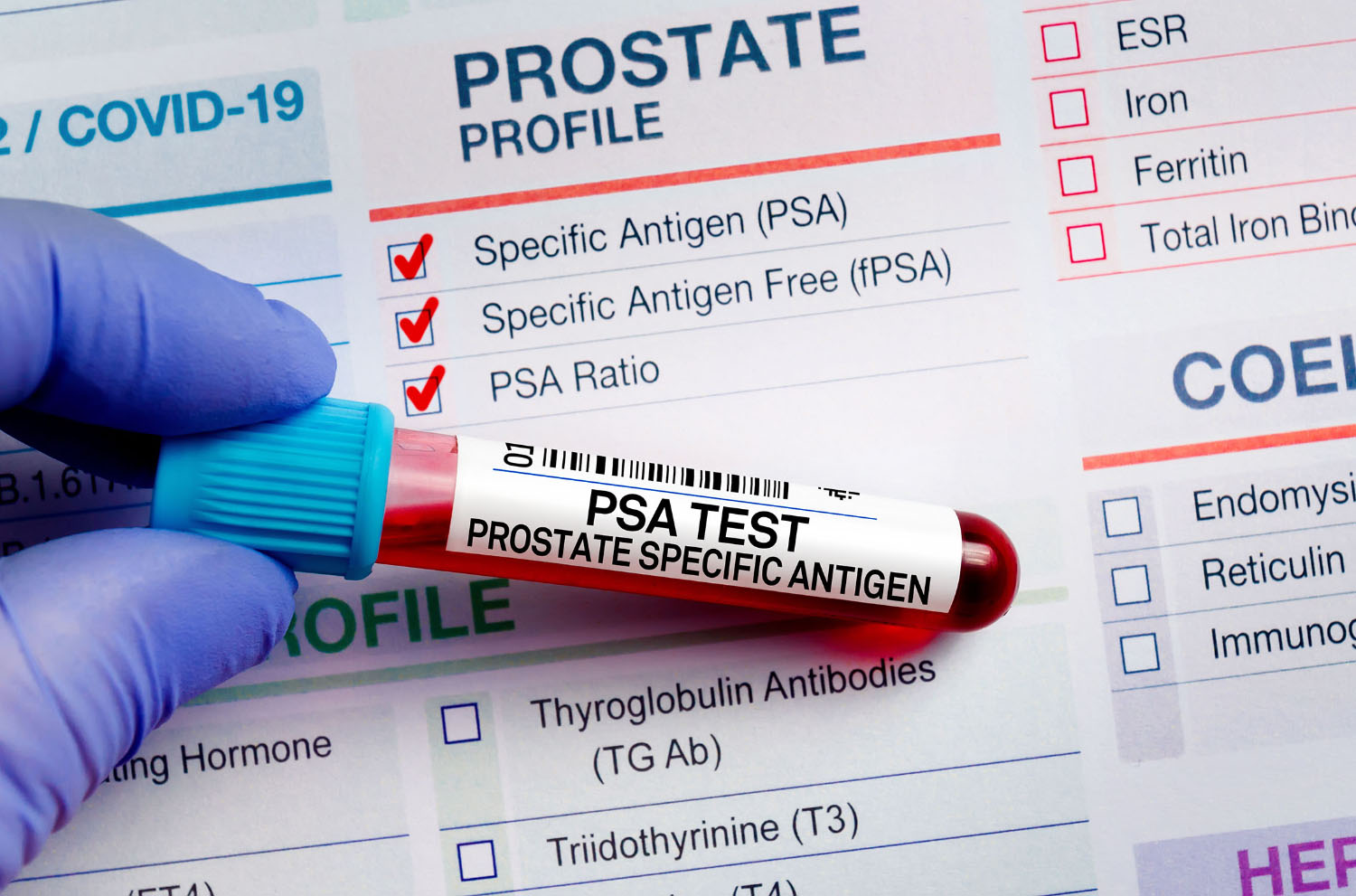PSA-Test mit Laborformular