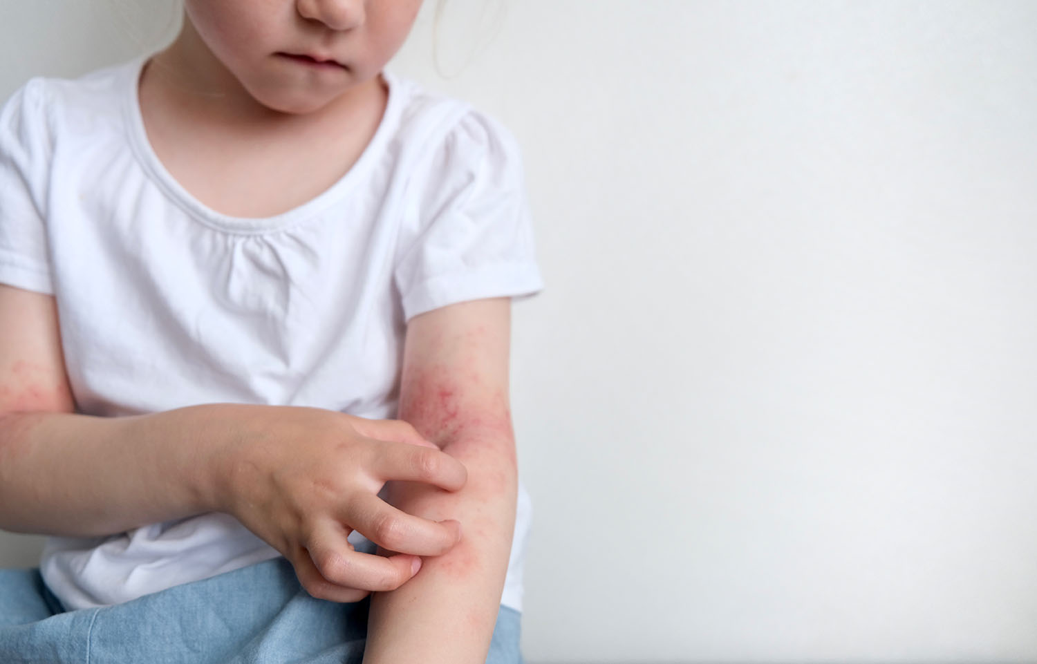 Atopische Dermatitis Neurodermitis Kind Haut