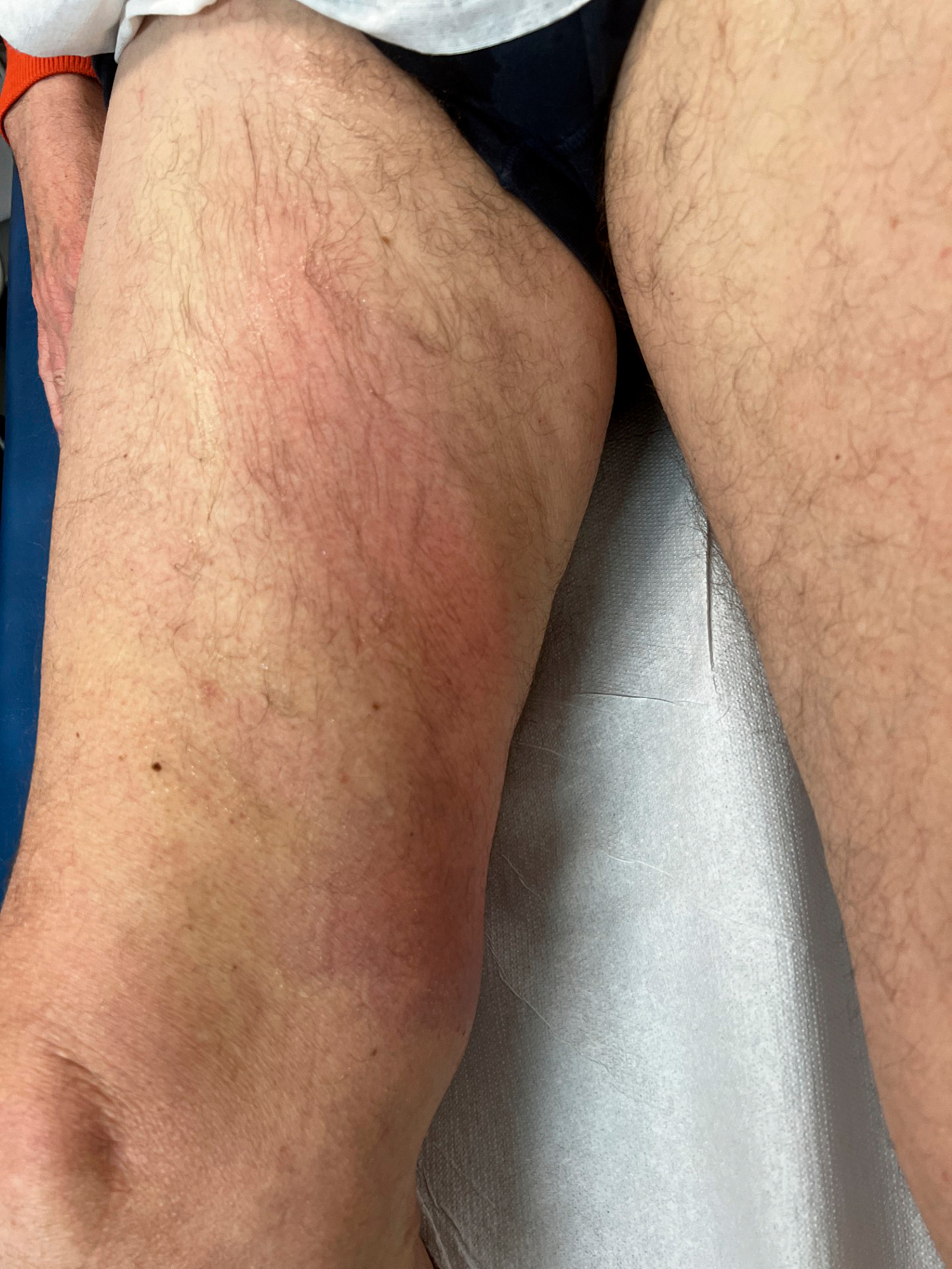 Therapie der oberflächlichen Venenthrombose